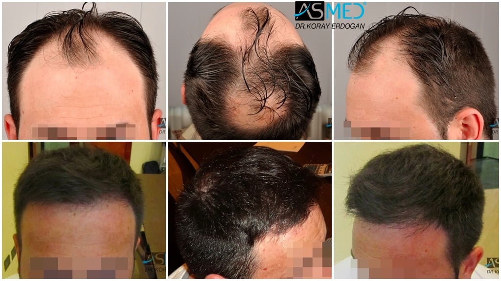 2600-grafts-FUE