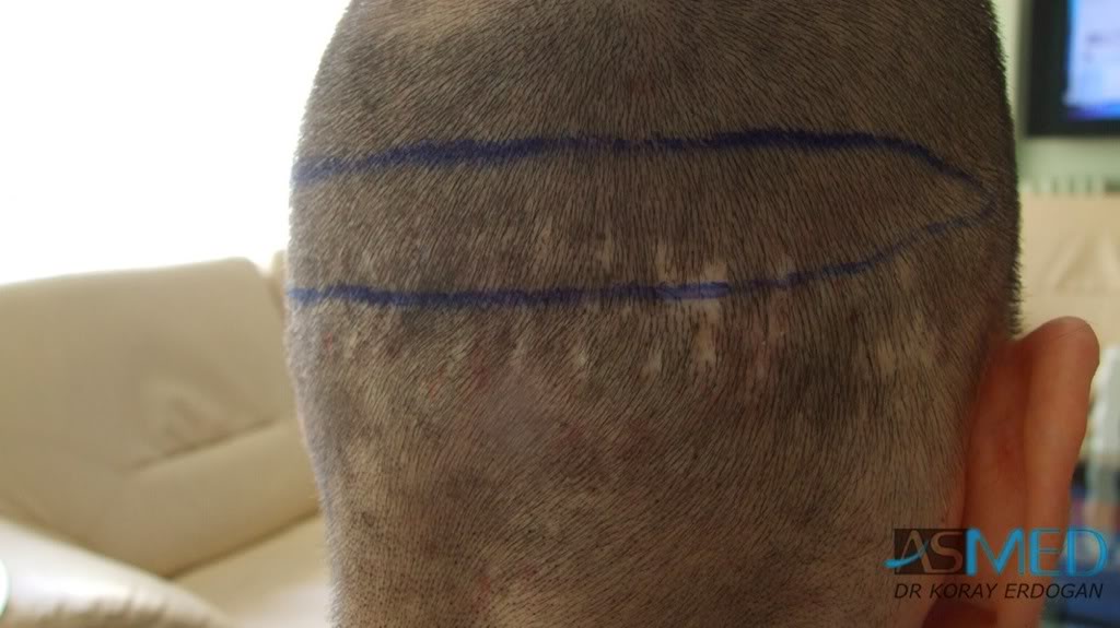 Norwood5 2700-grafts-FUE-Repair 045d6f3f