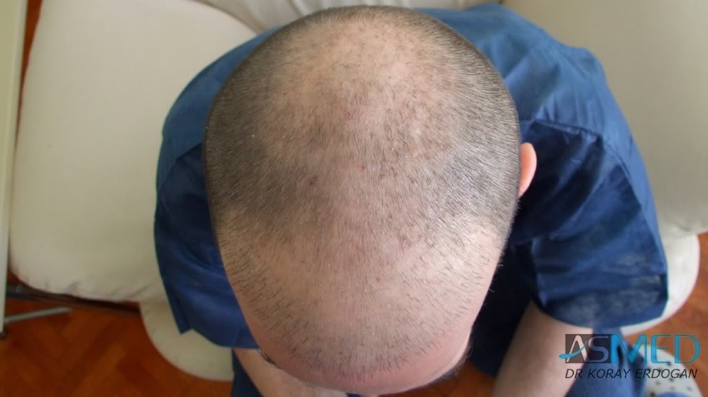 Norwood5 2700-grafts-FUE-Repair 06eb6849