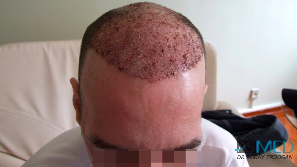 Norwood5 2700-grafts-FUE-Repair 2d9fb0be
