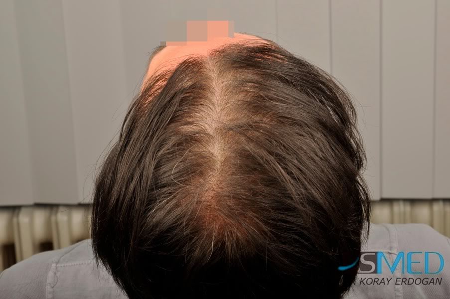 Norwood5 2700-grafts-FUE-Repair 32ac9646