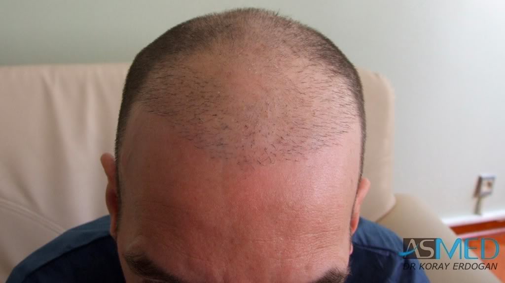 Norwood5 2700-grafts-FUE-Repair 51c534bb