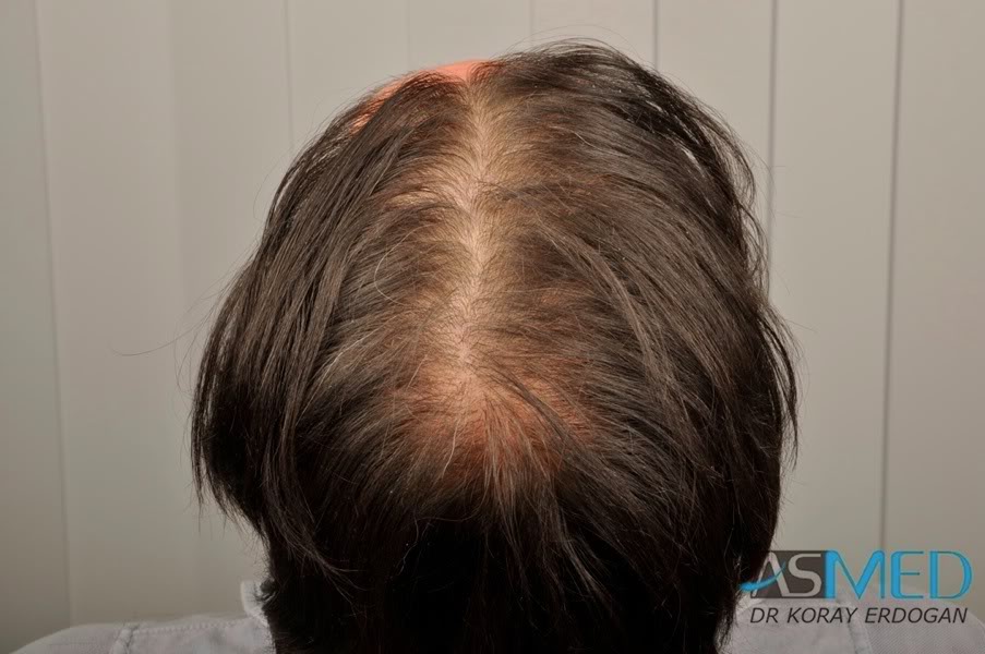Norwood5 2700-grafts-FUE-Repair 82d39480