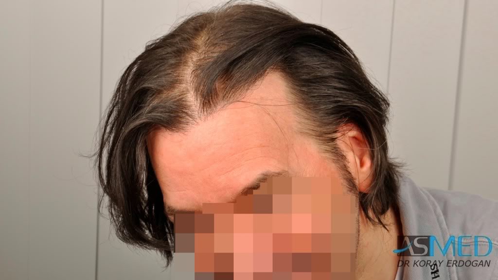 Norwood5 2700-grafts-FUE-Repair 93b3cc39