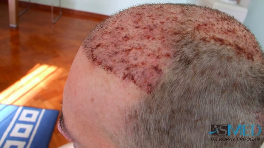 Norwood5 2700-grafts-FUE-Repair 961b01f2