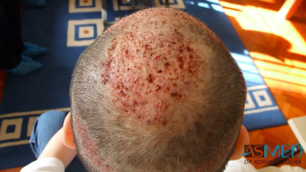 Norwood5 2700-grafts-FUE-Repair 979b7d40