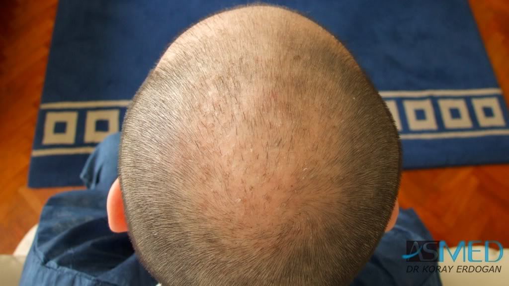 Norwood5 2700-grafts-FUE-Repair b44962ec