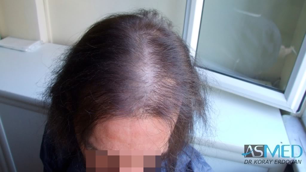 Norwood5 2700-grafts-FUE-Repair fa994290