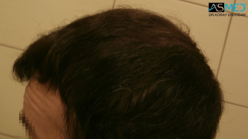 Norwood5 3212-grafts-FUE-Repair file_zps0bfd4646
