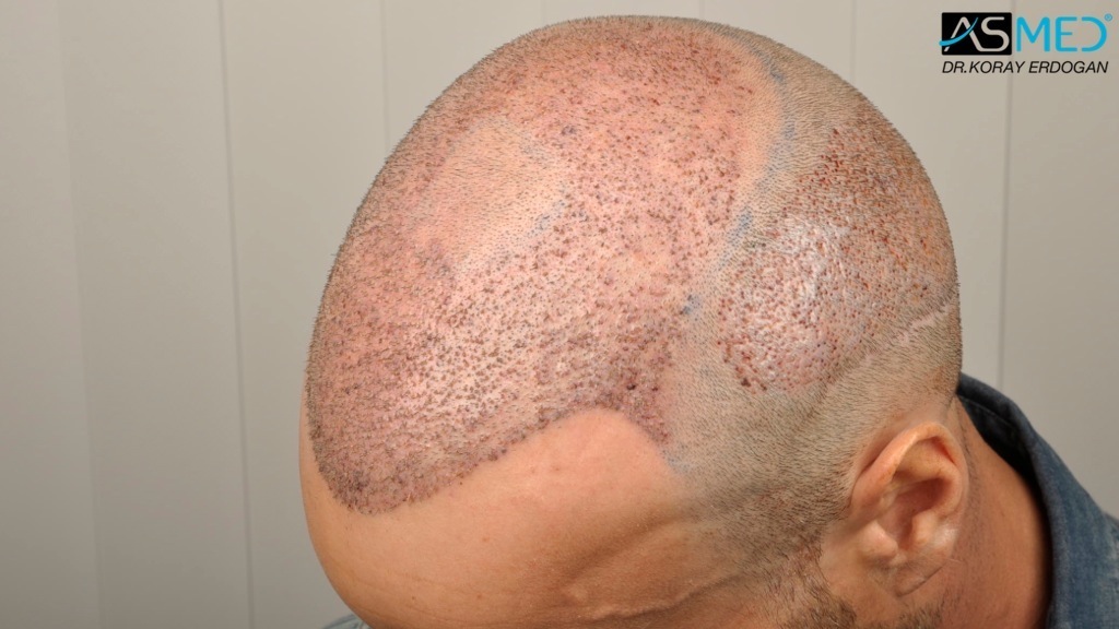 Norwood5 3212-grafts-FUE-Repair file_zps0e335658