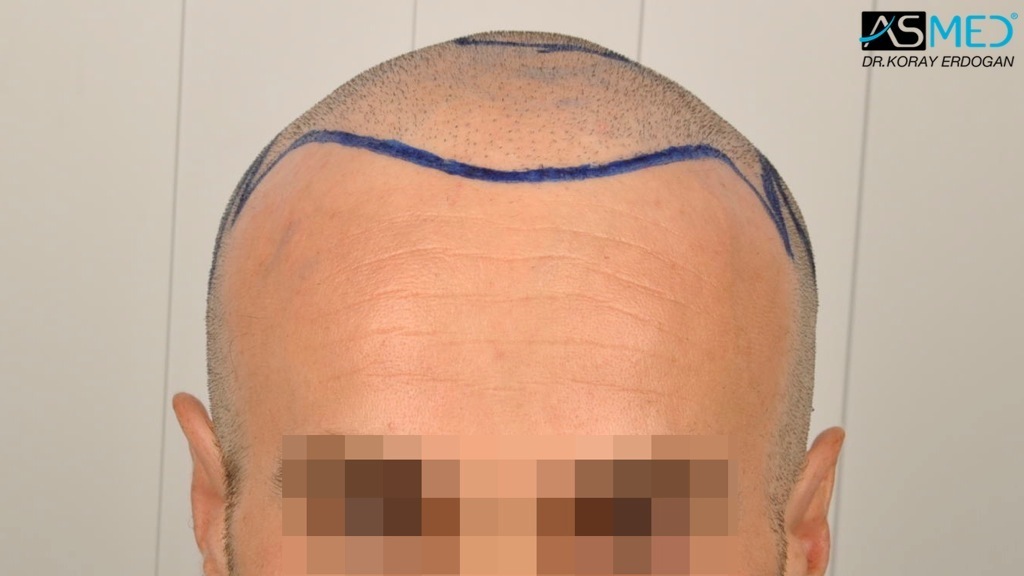 Norwood5 3212-grafts-FUE-Repair file_zps14ad9128