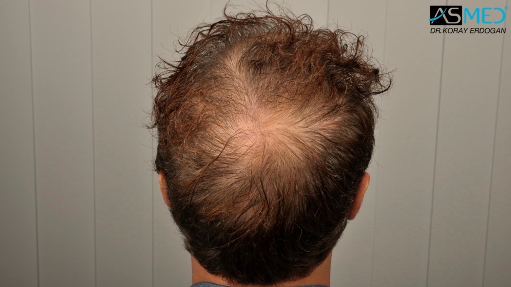 Norwood5 3212-grafts-FUE-Repair file_zps1c88758e