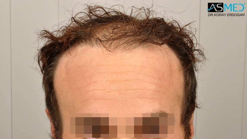 Norwood5 3212-grafts-FUE-Repair file_zps2023106c