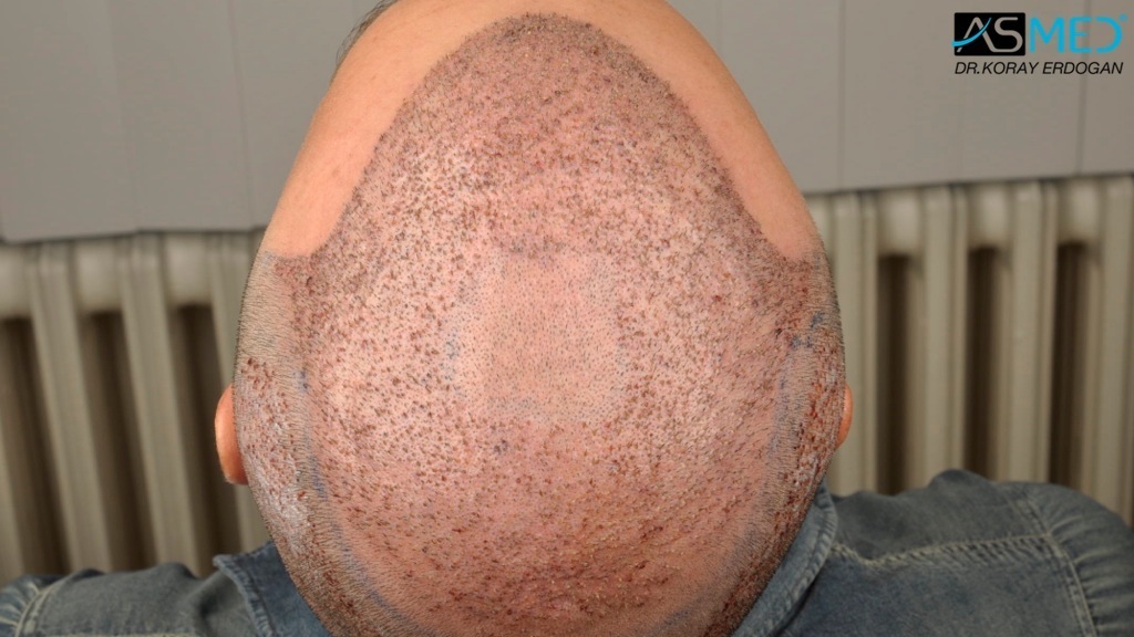 Norwood5 3212-grafts-FUE-Repair file_zps30ae3179