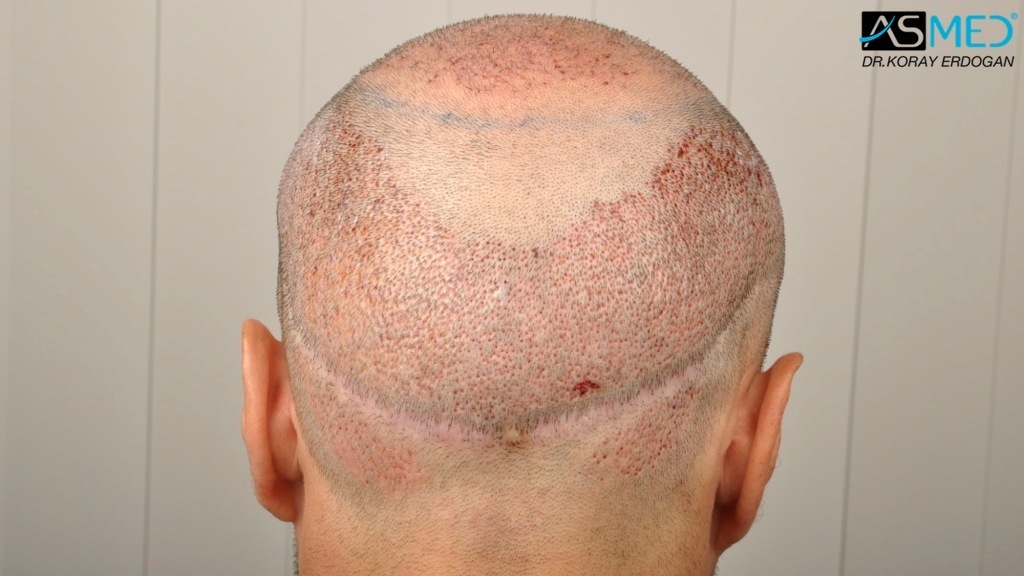 Norwood5 3212-grafts-FUE-Repair file_zps3f9aff74