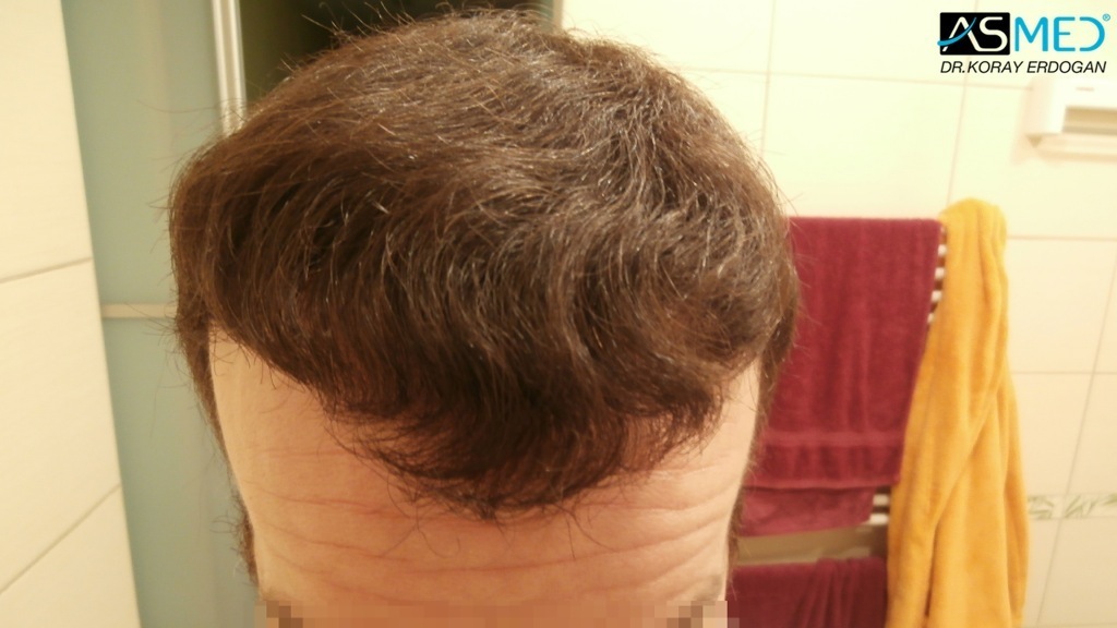 Norwood5 3212-grafts-FUE-Repair file_zps5308d055