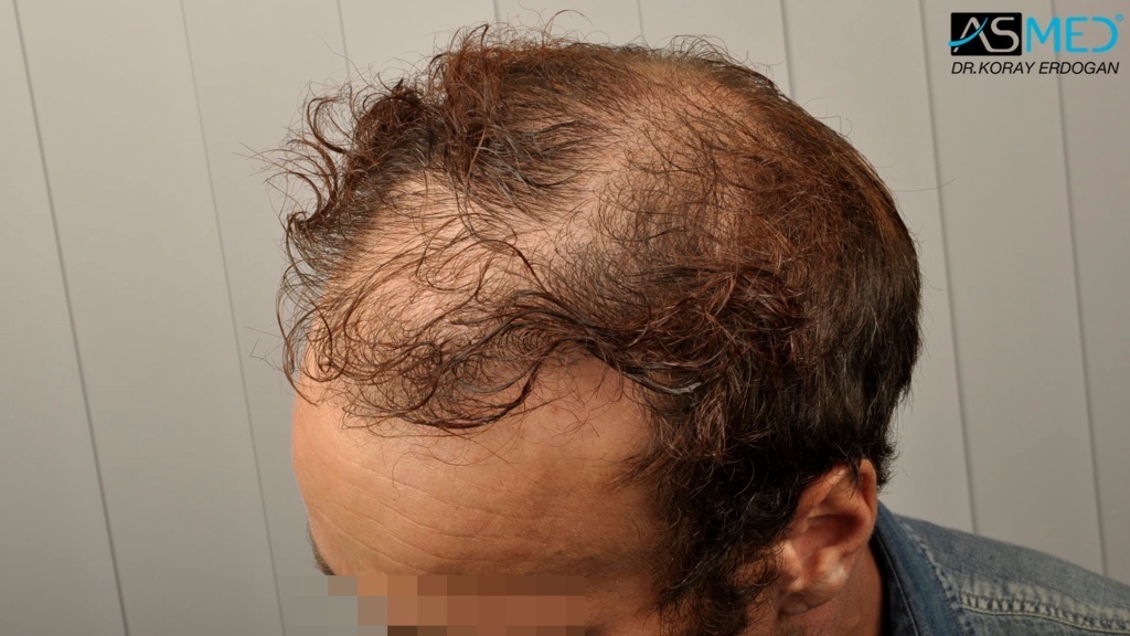 Norwood5 3212-grafts-FUE-Repair file_zps5340ee33