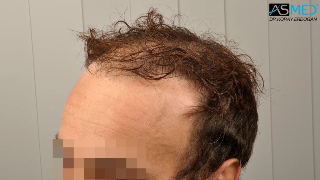 Norwood5 3212-grafts-FUE-Repair file_zps6908db95