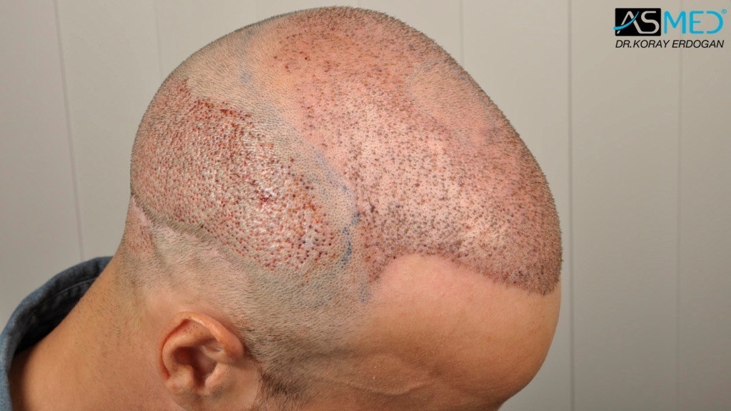 Norwood5 3212-grafts-FUE-Repair file_zps6a0c7a40