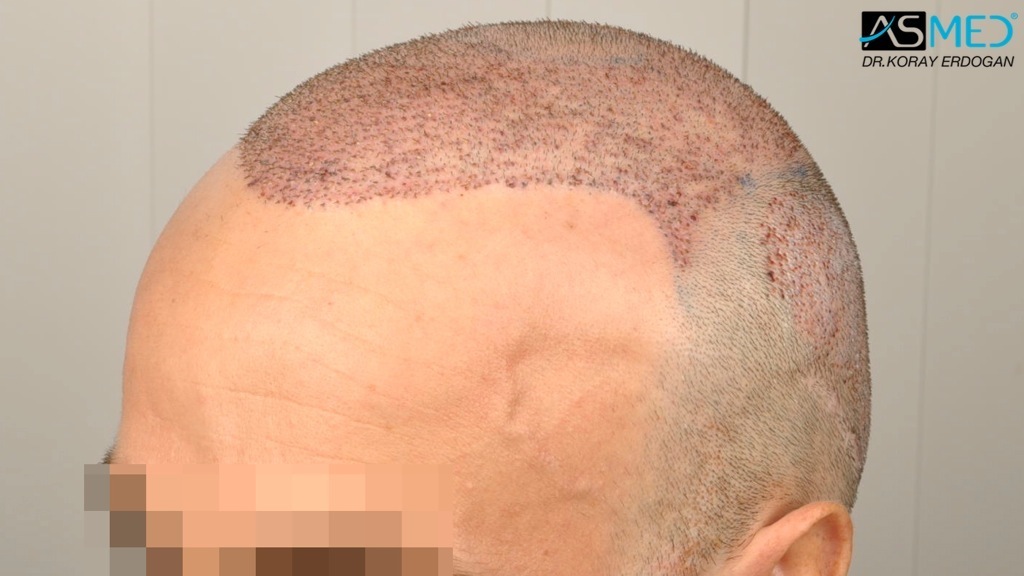 Norwood5 3212-grafts-FUE-Repair file_zps7f298184