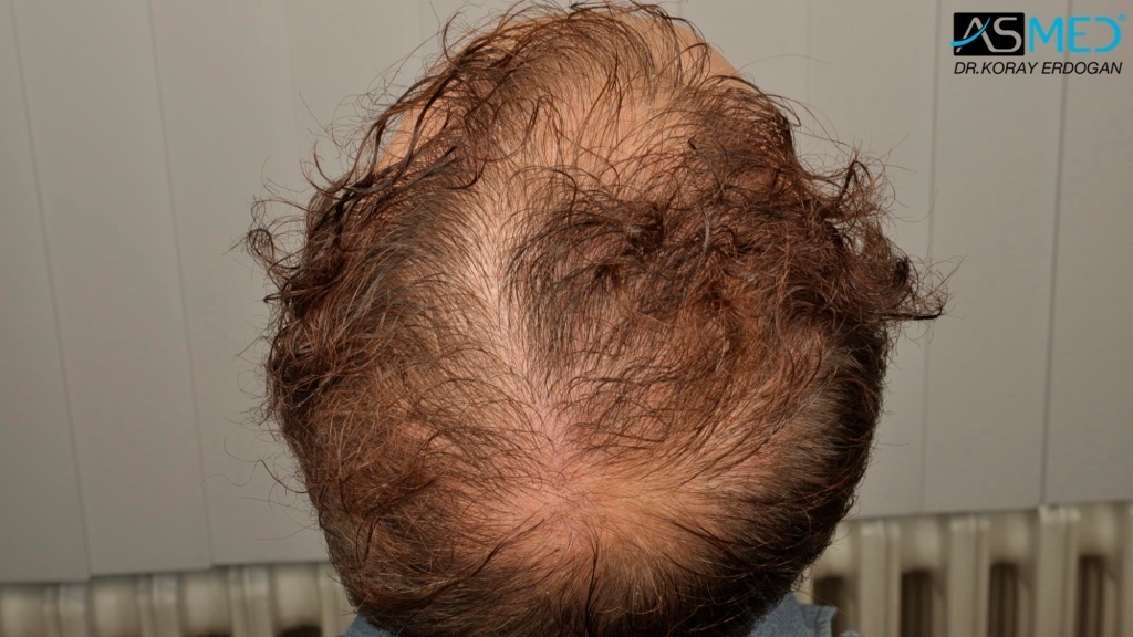 Norwood5 3212-grafts-FUE-Repair file_zps950d5f9a