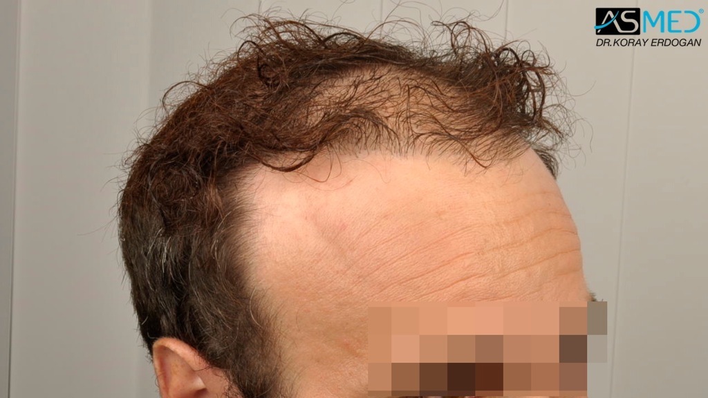 Norwood5 3212-grafts-FUE-Repair file_zpsa46fc958