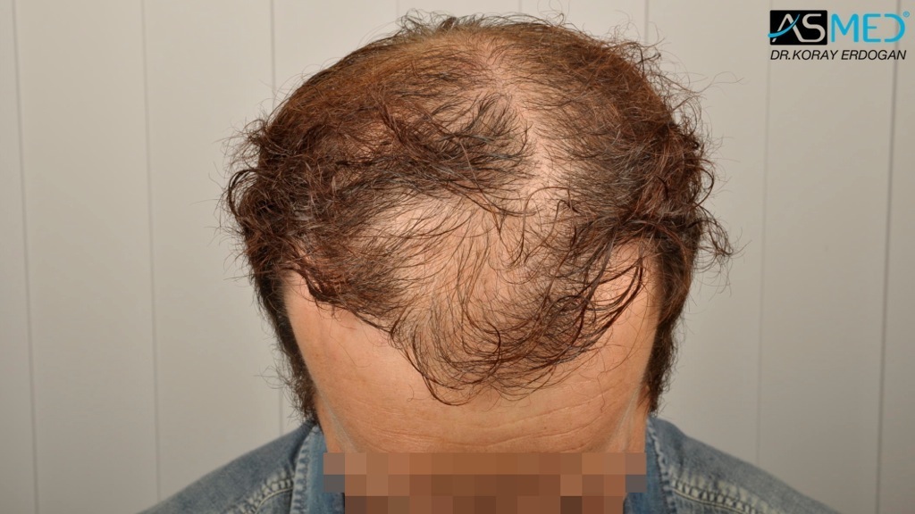 Norwood5 3212-grafts-FUE-Repair file_zpsb1e9fd37