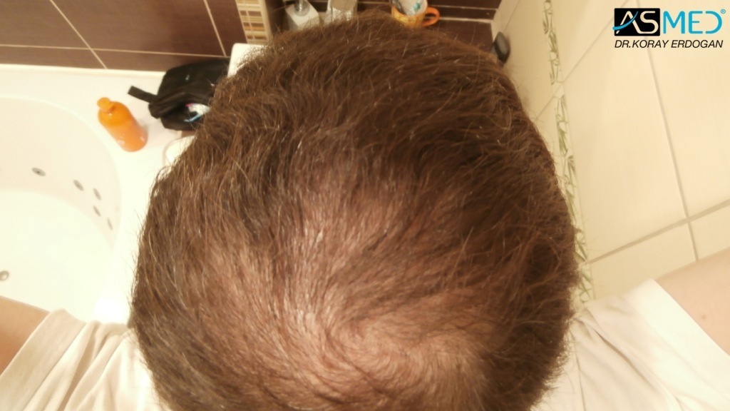 Norwood5 3212-grafts-FUE-Repair file_zpsb635184f