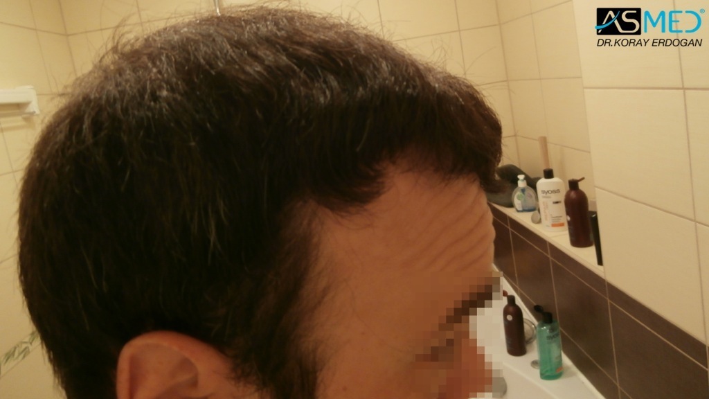Norwood5 3212-grafts-FUE-Repair file_zpsf1d5a0d0