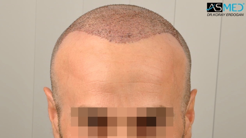 Norwood5 3212-grafts-FUE-Repair file_zpsfd99f99d