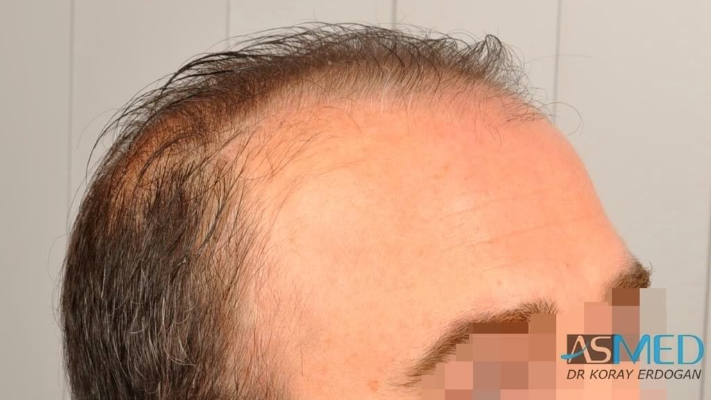 Norwood5 3231-grafts-FUE 03eb4e66