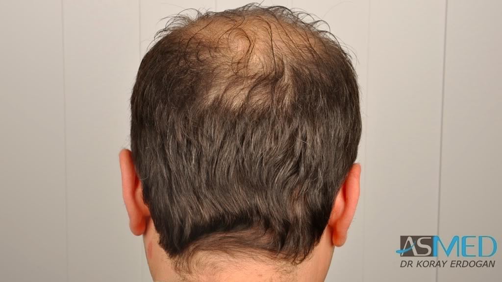 Norwood5 3231-grafts-FUE 0f2c9c41