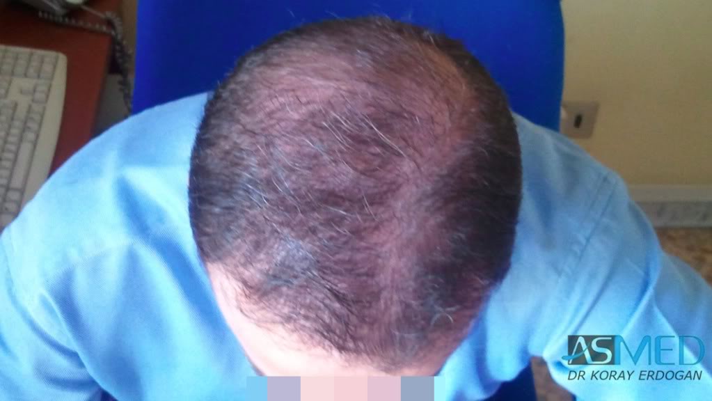 Norwood5 3231-grafts-FUE 1508b884