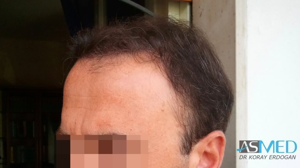 Norwood5 3231-grafts-FUE 1765aa28