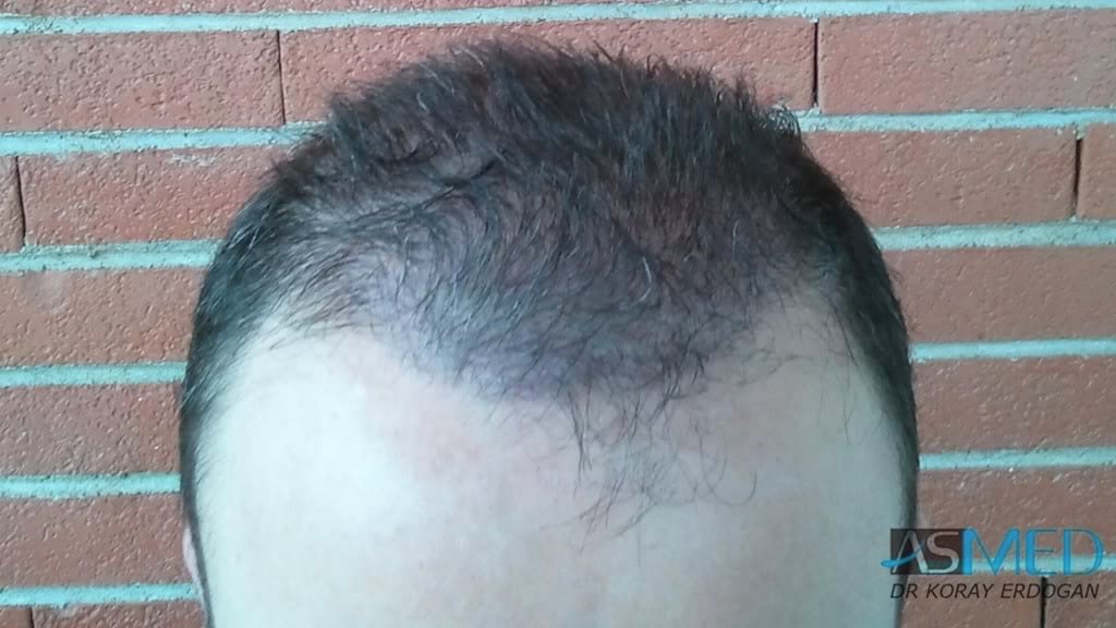 Norwood5 3231-grafts-FUE 2b1da114