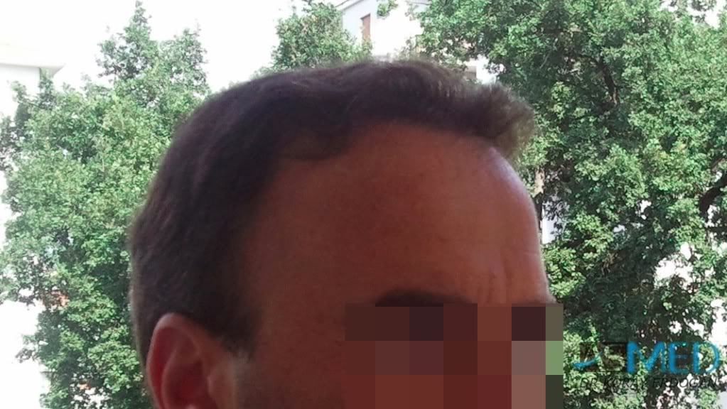 Norwood5 3231-grafts-FUE 30a2f805