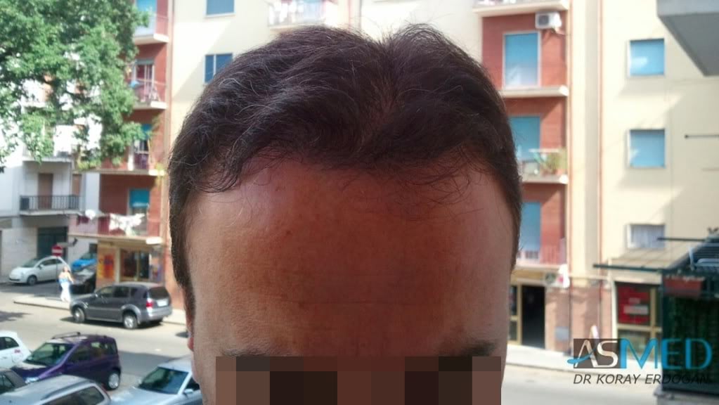 Norwood5 3231-grafts-FUE 31427ce4