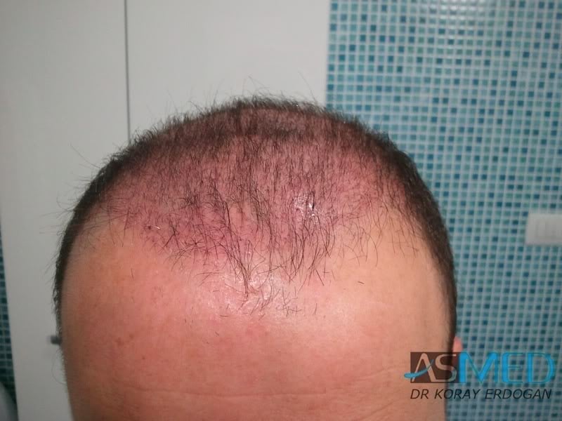 Norwood5 3231-grafts-FUE 32a4496c