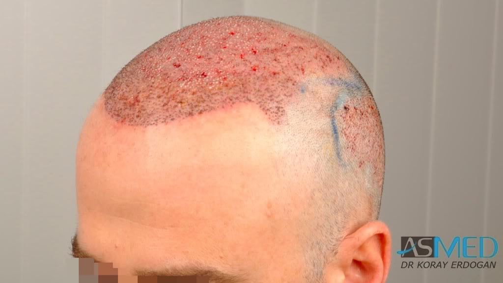 Norwood5 3231-grafts-FUE 330fdc0b