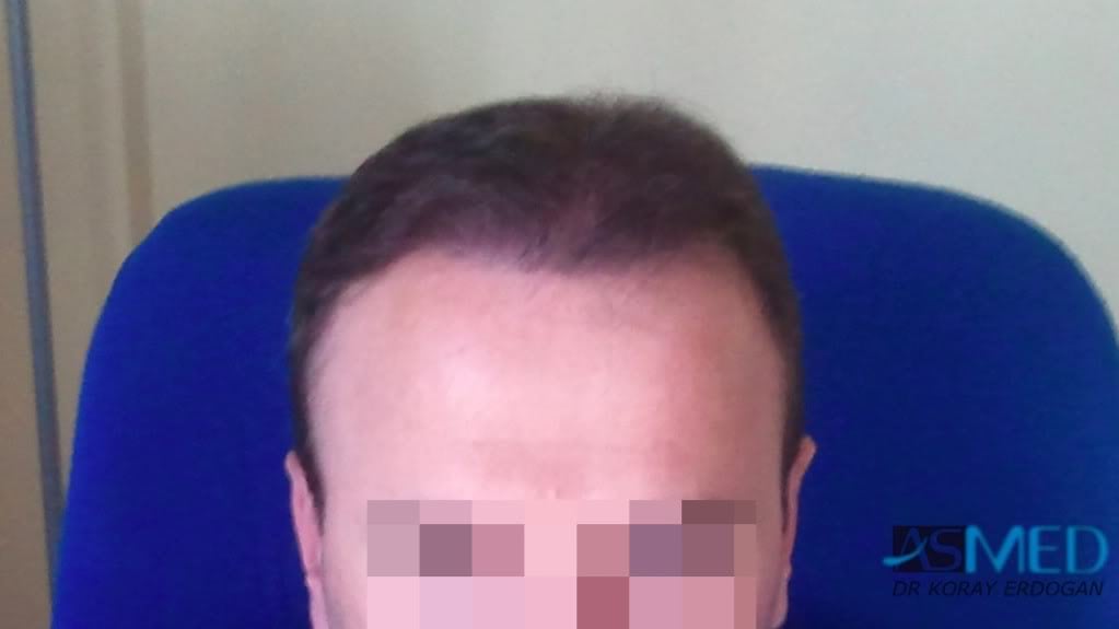Norwood5 3231-grafts-FUE 393bd92b