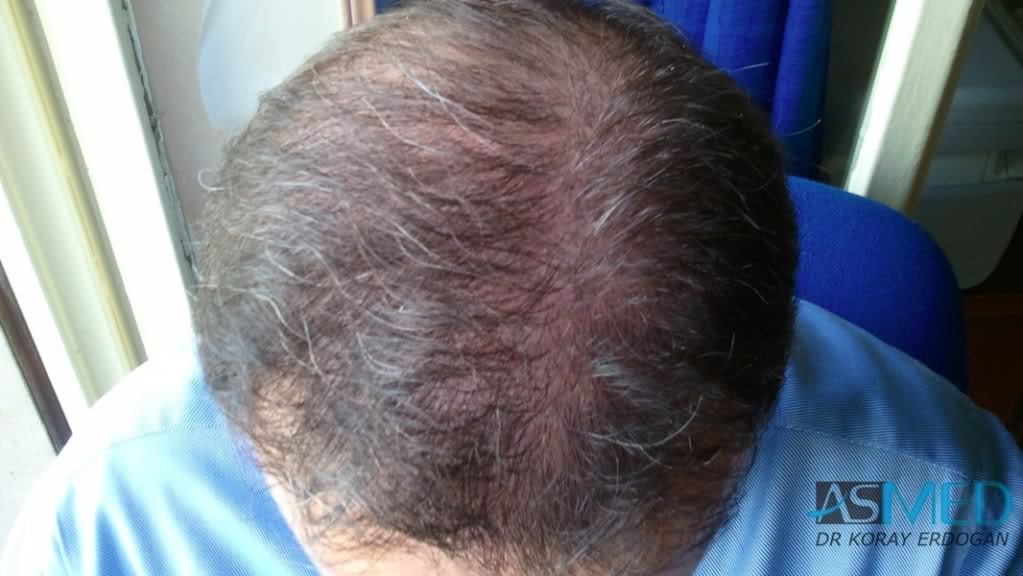 Norwood5 3231-grafts-FUE 40828ed5