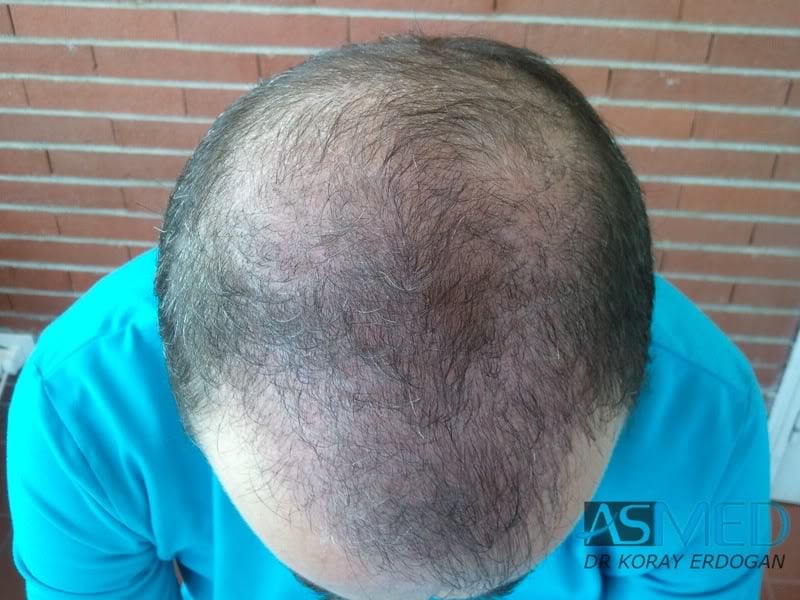 Norwood5 3231-grafts-FUE 54b524de