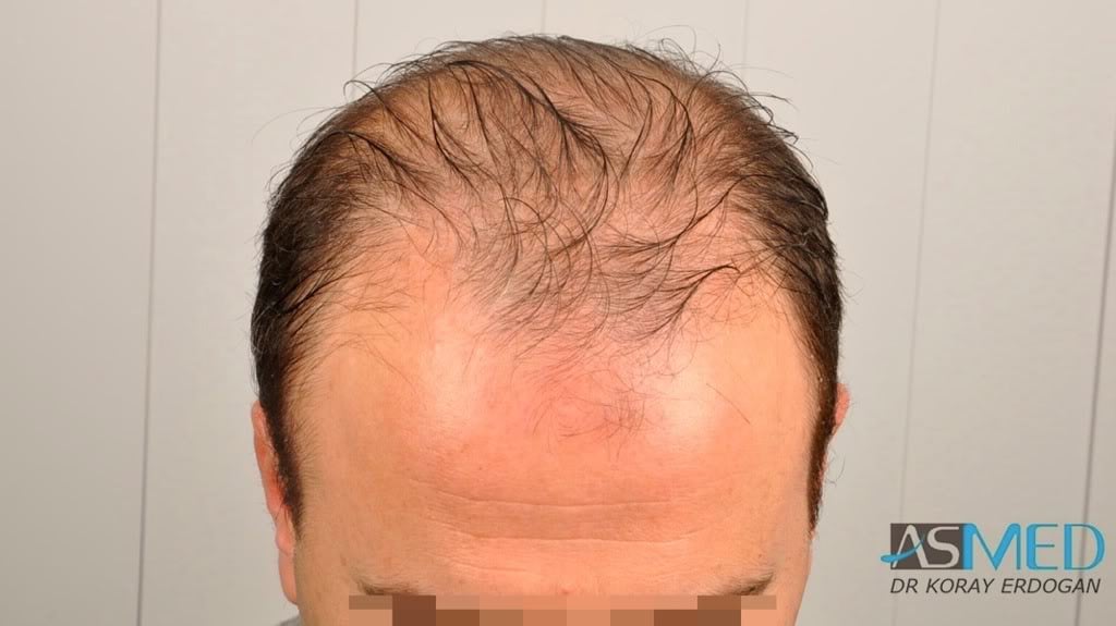 Norwood5 3231-grafts-FUE 768a4ecc