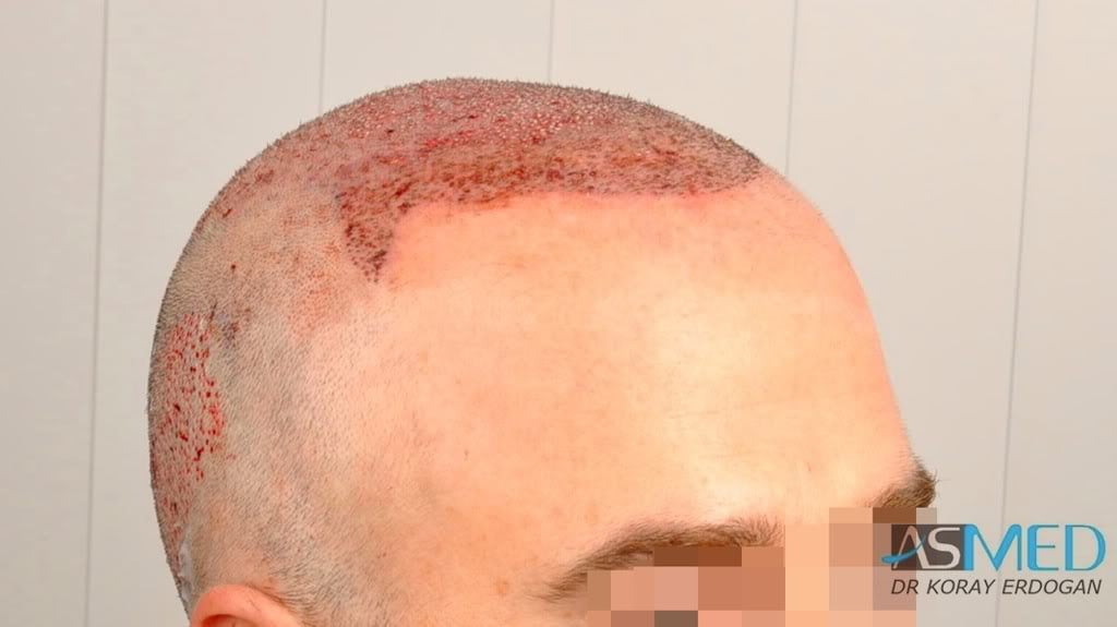 Norwood5 3231-grafts-FUE 7803e1b9