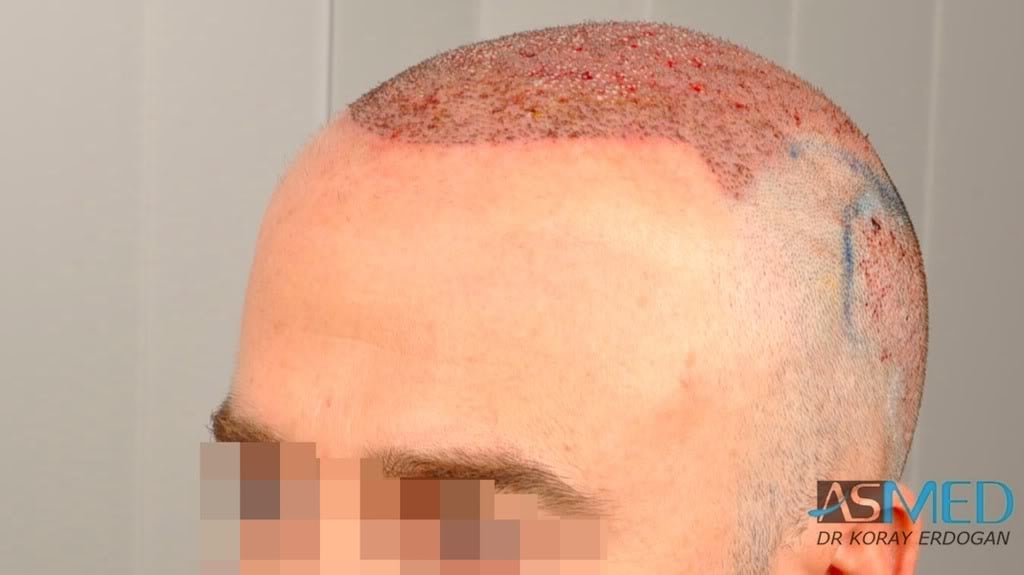 Norwood5 3231-grafts-FUE 880cf0c1