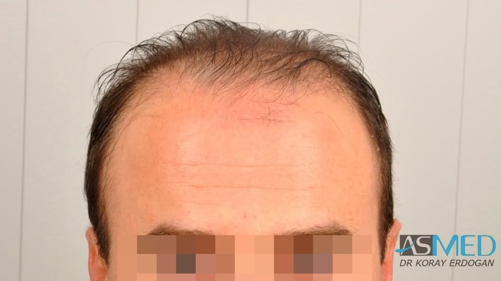 Norwood5 3231-grafts-FUE 901d8bc6