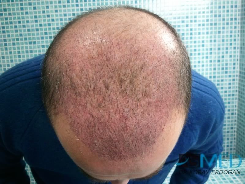 Norwood5 3231-grafts-FUE 97c87553