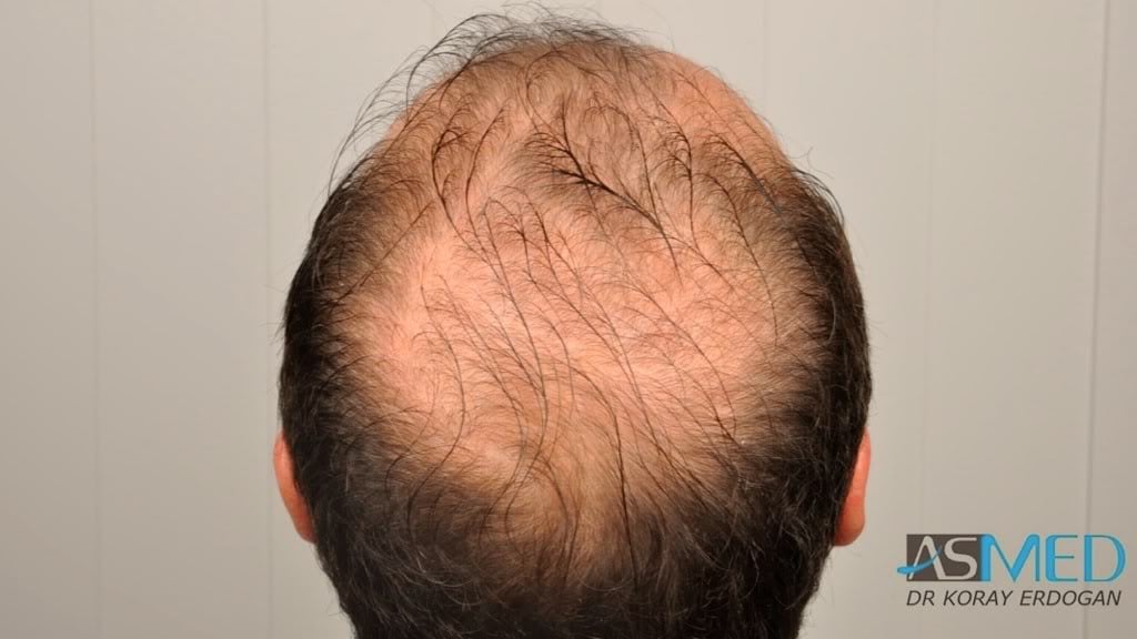 Norwood5 3231-grafts-FUE 9c16ea71