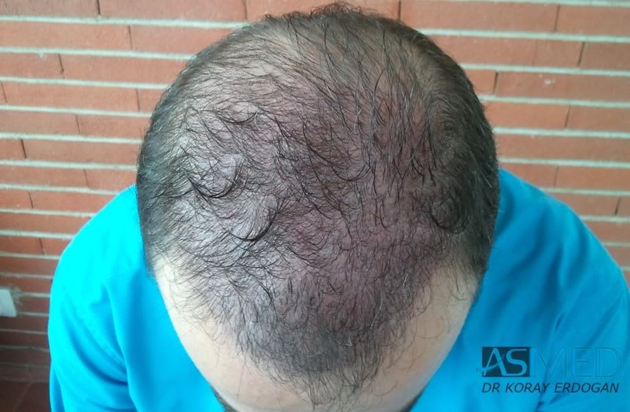 Norwood5 3231-grafts-FUE a6348b18