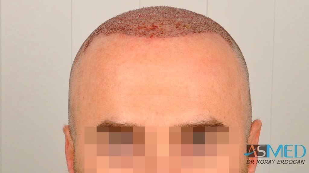 Norwood5 3231-grafts-FUE aa5011f4